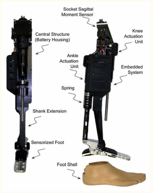  Frontal and Side Views of Transfemoral Prosthesis