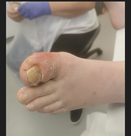 Diabetic foot ulcer