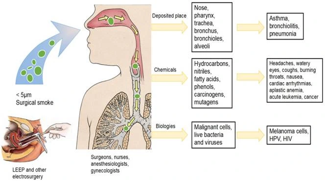 Effects of Surgical Smoke