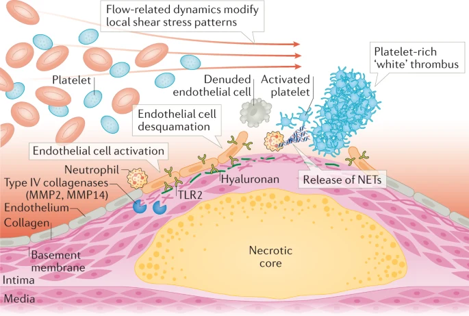 Plaque erosion and acute coronary syndromes