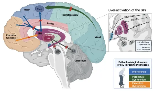 Pathophysiological model of freezing of gait Pathophysiological model of freezing of gait