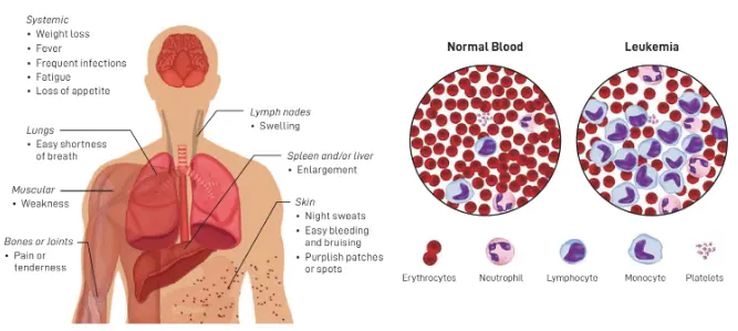 Figure 1: Common Symptoms of Leukemia