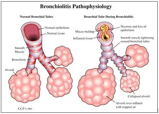 The pathophysiology of bronchiolitis