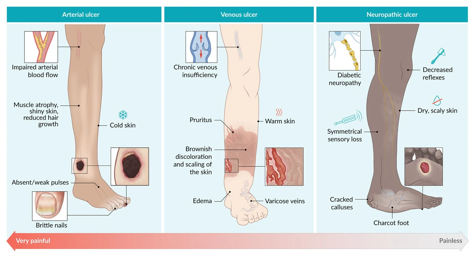 The symptoms of Foot ulcer